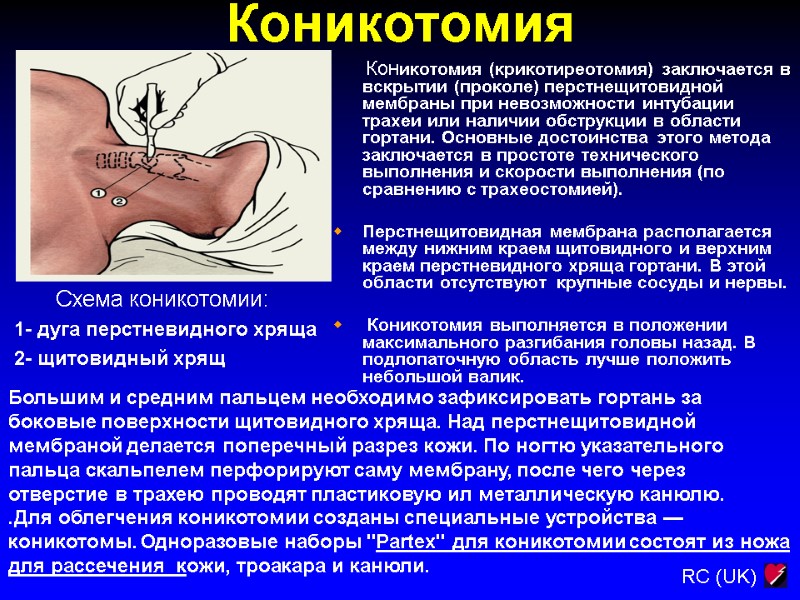 Коникотомия  Схема коникотомии:  1- дуга перстневидного хряща  2- щитовидный хрящ 